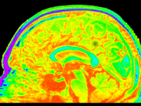 Brain Tissue Donation image